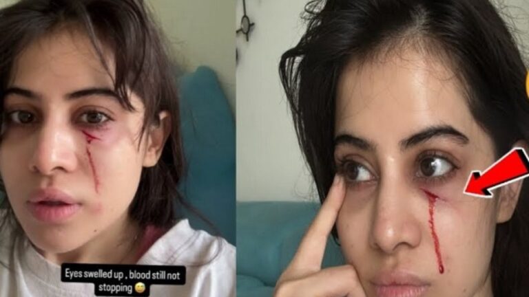 पालतू बिल्ली के हमले से लहूलुहान हुईं Urfi Javed, चेहरा खून से लथपथ और आंखें सूजीं, फिर भी हंसती रहीं उर्फी